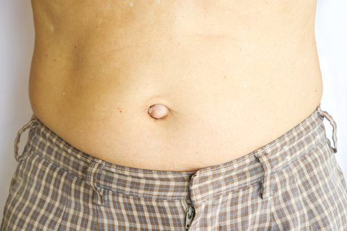 painful-growth-in-woman-s-belly-button-was-a-sign-of-ovarian-cancer