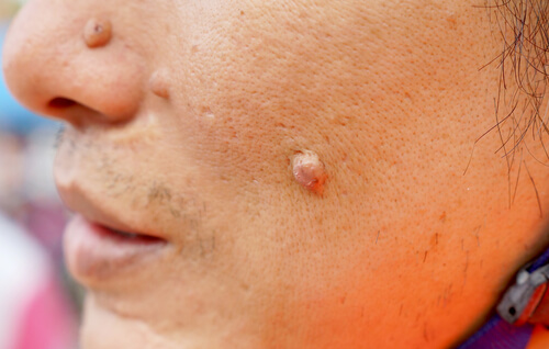 10-ways-to-spot-cancerous-moles-page-2-of-15