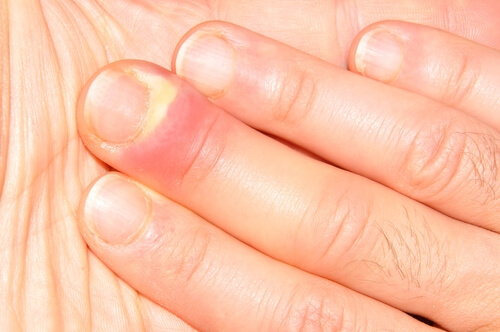 14 Signs Your Nails Are Infected with Paronychia