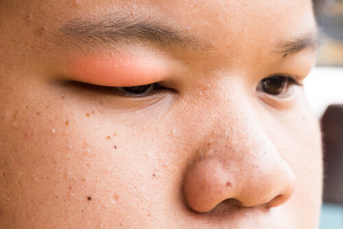 14 Things That Cause Droopy Eyelid