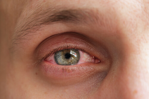 14 Common Symptoms of Eye Ulcer