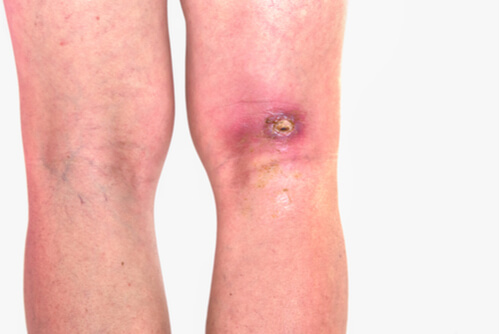 14-things-to-know-about-popliteal-baker-s-cyst