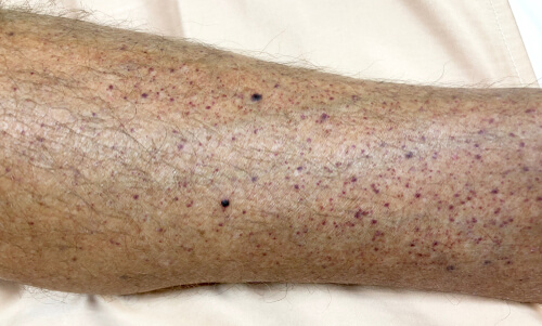 Immune Thrombocytopenia Leg 