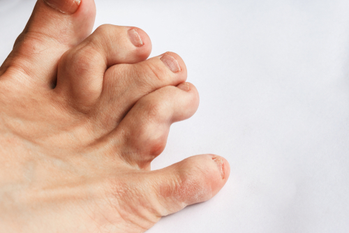 14 Frequent Symptoms of A Broken Toe - Page 8 of 15