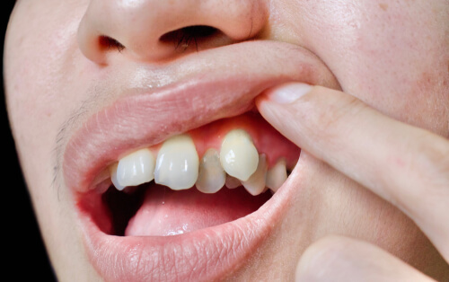 14-common-causes-of-gum-pain